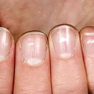 Микотическая лейконихия