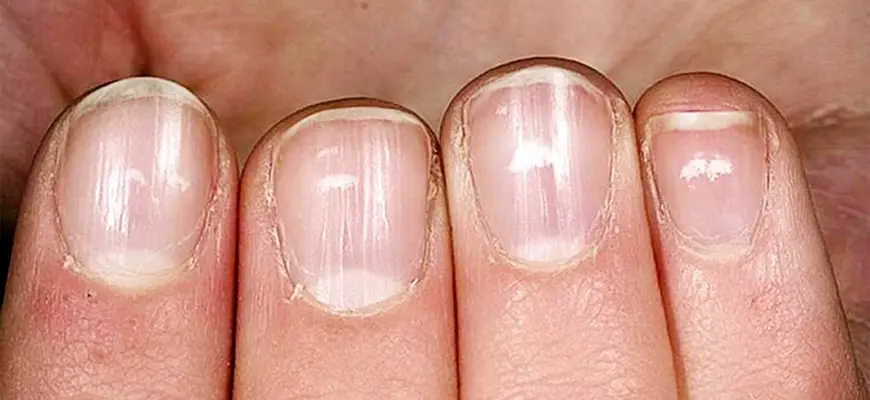 Микотическая лейконихия
