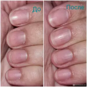 После аппаратного маникюра